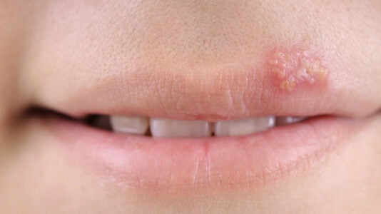 herpes labial y oral